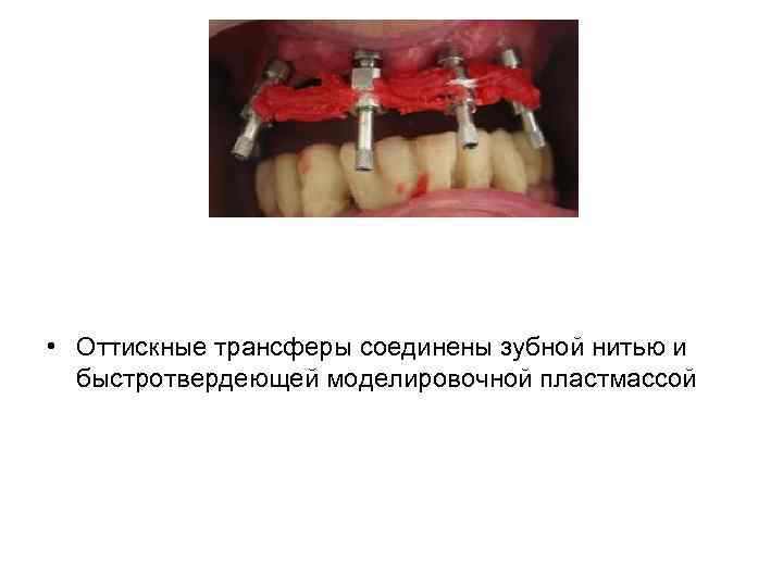  • Оттискные трансферы соединены зубной нитью и быстротвердеющей моделировочной пластмассой 