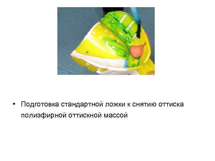  • Подготовка стандартной ложки к снятию оттиска полиэфирной оттискной массой 