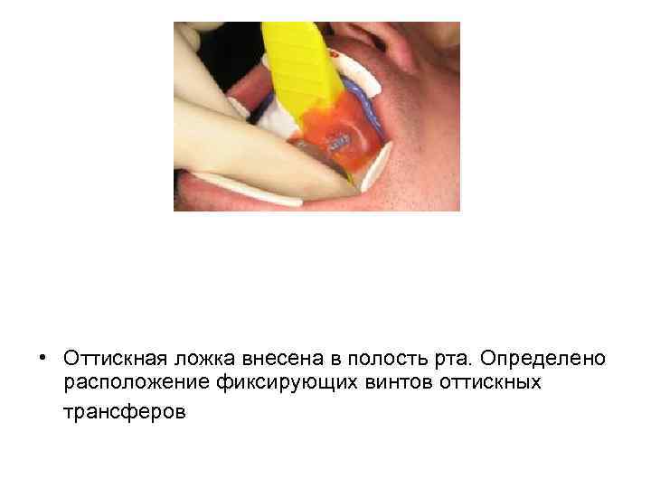  • Оттискная ложка внесена в полость рта. Определено расположение фиксирующих винтов оттискных трансферов