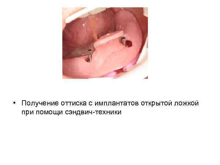 • Получение оттиска с имплантатов открытой ложкой при помощи сэндвич-техники 