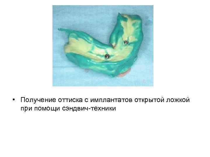 • Получение оттиска с имплантатов открытой ложкой при помощи сэндвич-техники 