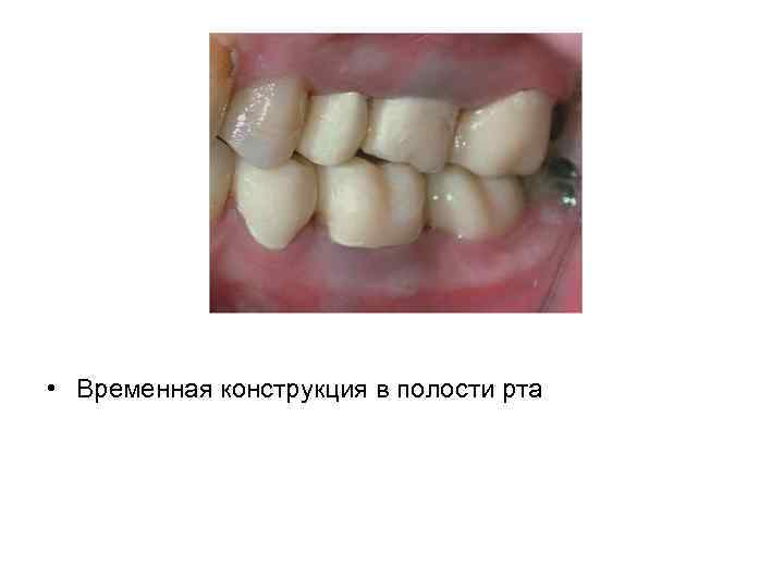 • Временная конструкция в полости рта 