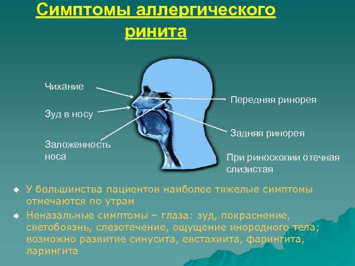 Симптомы аллергического ринита Чихание Передняя ринорея Зуд в носу Задняя ринорея Заложенность носа u