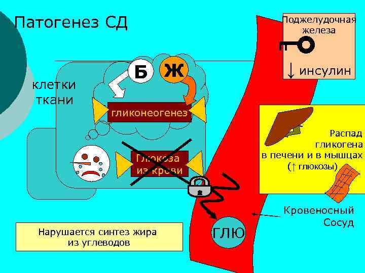 Патогенез СД клетки ткани Поджелудочная железа ↓ инсулин Б Ж гликонеогенез Распад гликогена в