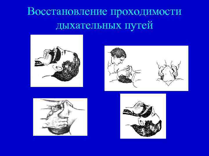 Последовательность восстановления проходимости дыхательных путей. Оценка проходимости дыхательных путей. Наборы для восстановления проходимости дыхательных путей. Шкала проходимости дыхательных путей. Восстание проходимости дых путей.