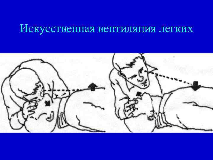 Искусственная вентиляция легких 