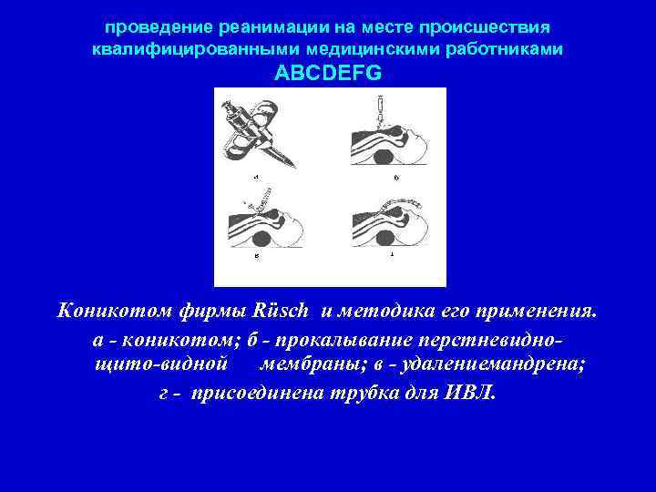 проведение реанимации на месте происшествия квалифицированными медицинскими работниками ABCDEFG Коникотом фирмы Rüsch и методика