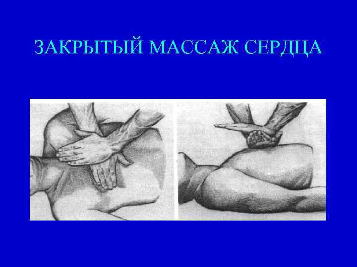 ЗАКРЫТЫЙ МАССАЖ СЕРДЦА 