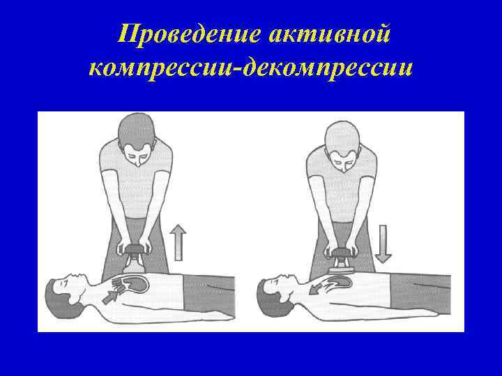Проведение активной компрессии декомпрессии 
