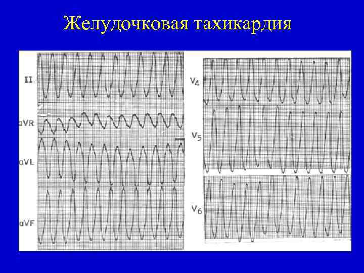 Желудочковая тахикардия 