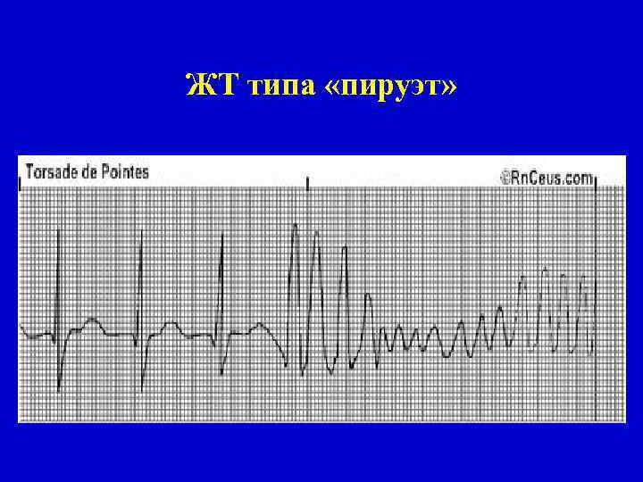 Жт типа пируэт картинки