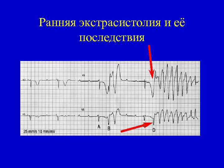 Ранняя экстрасистолия и её последствия 