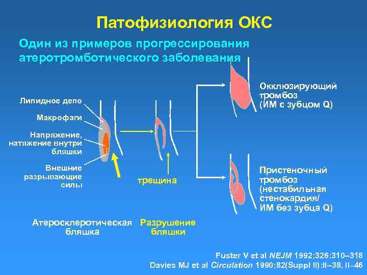 Патофизиология ОКС Один из примеров прогрессирования атеротромботического заболевания Окклюзирующий тромбоз (ИМ с зубцом Q)