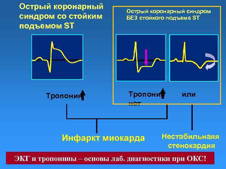 Острым коронарным синдромом без. ИБС острый коронарный синдром без подъема сегмента St. ЭКГ при инфаркте миокарда без подъема сегмента St. ЭКГ при инфаркте миокарда с подъемом сегмента St. Подъем сегмента St на ЭКГ.