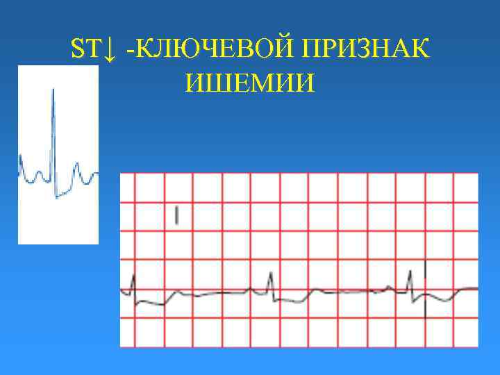 ST↓ -КЛЮЧЕВОЙ ПРИЗНАК ИШЕМИИ 