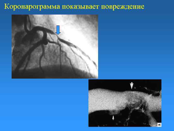 Коронарограмма показывает повреждение 