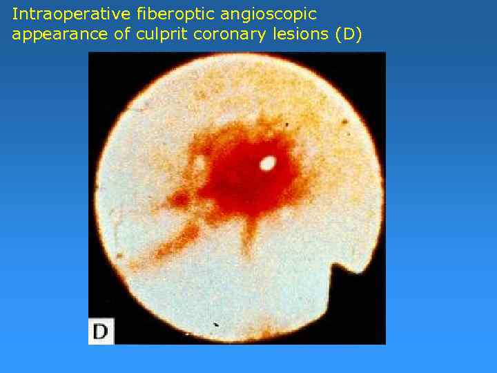 Intraoperative fiberoptic angioscopic appearance of culprit coronary lesions (D) 