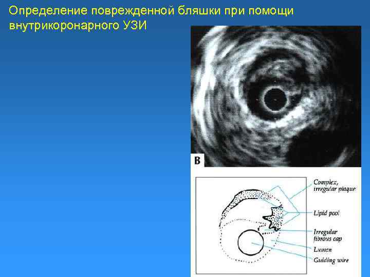 Определение поврежденной бляшки при помощи внутрикоронарного УЗИ 