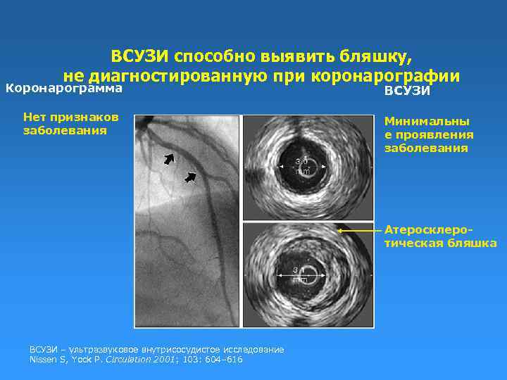 Узи коронарных артерий. Внутрисосудистое ультразвуковое исследование коронарных артерий. Внутрикоронарное ультразвуковое исследование. ВСУЗИ коронарных артерий. Внутрисосудистое УЗИ.
