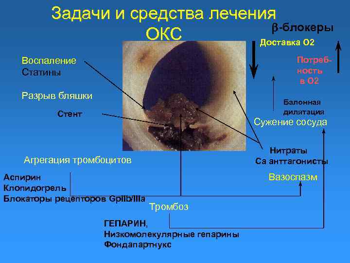 Задачи и средства лечения -блокеры ОКС Доставка О 2 Потребность в О 2 Воспаление