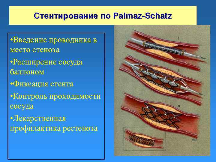 Стентирование по Palmaz-Schatz • Введение проводника в место стеноза • Расширение сосуда баллоном •