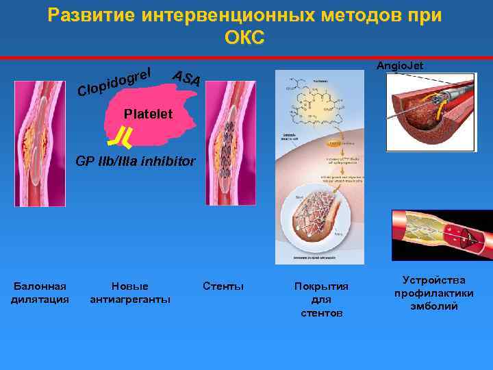 Развитие интервенционных методов при ОКС l ogre lopid C Angio. Jet ASA Platelet GP