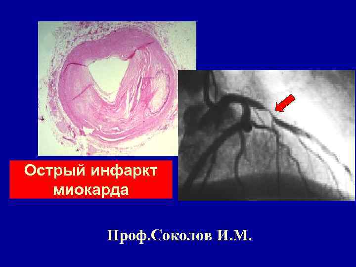 Острый инфаркт миокарда Проф. Соколов И. М. 