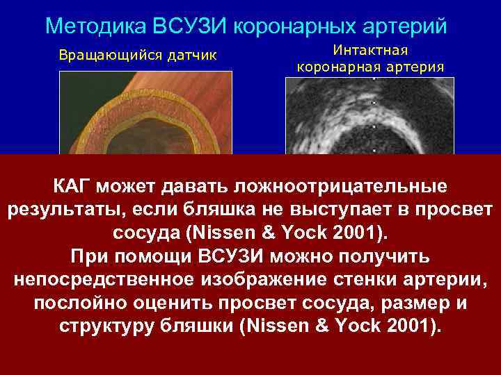 Методика ВСУЗИ коронарных артерий Вращающийся датчик Интактная коронарная артерия КАГ может давать ложноотрицательные результаты,