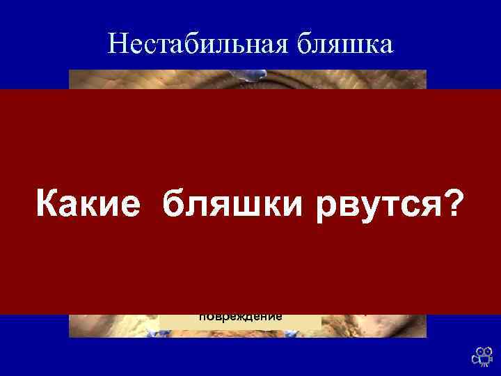 Нестабильная бляшка Какие бляшки рвутся? Атеросклеротическое повреждение 