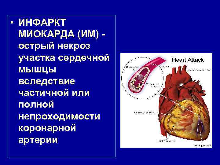  • ИНФАРКТ МИОКАРДА (ИМ) - острый некроз участка сердечной мышцы вследствие частичной или