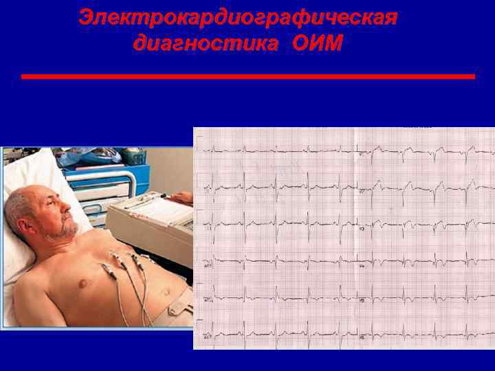 Электрокардиографическая диагностика ОИМ 