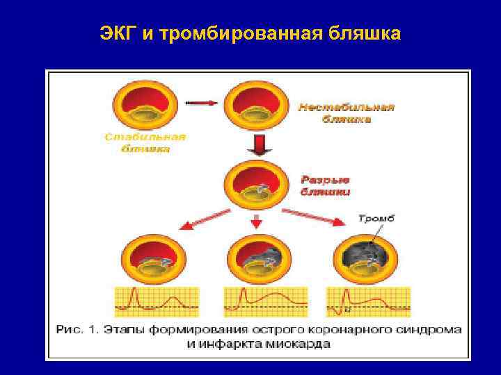 ЭКГ и тромбированная бляшка 