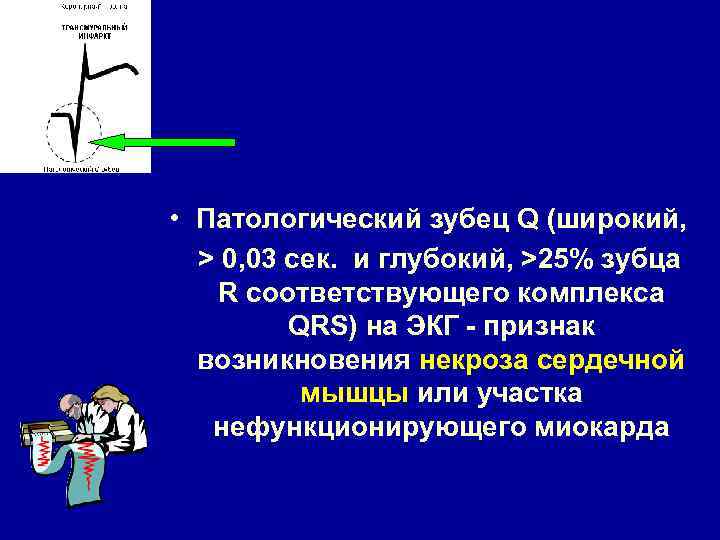 Для патологического зубца q характерно. Механизм формирования патологического зубца q или. Патологический зубец q при инфаркте. Признаки патологического зубца q. Механизм формирования патологического зубца QS или q..