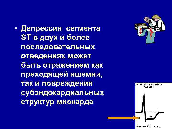  • Депрессия сегмента ST в двух и более последовательных отведениях может быть отражением