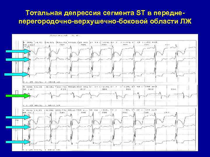 Тотальная депрессия сегмента ST в переднеперегородочно-верхушечно-боковой области ЛЖ 