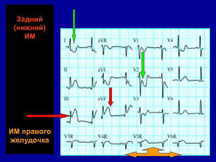 Задний (нижний) ИМ ИМ правого желудочка 