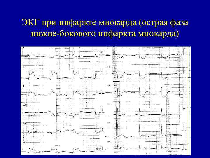 ЭКГ при инфаркте миокарда (острая фаза нижне-бокового инфаркта миокарда) 