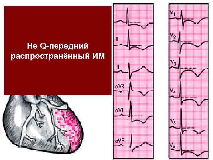 Не Q-передний распространённый ИМ 