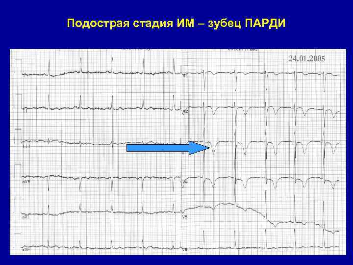 Подострая стадия ИМ – зубец ПАРДИ 24. 01. 2005 