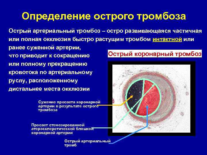 Коронарный тромбоз причина. Острый артериальной тробоз. Острый коронарный тромбоз. Острый артериальный тромбоз классификация.