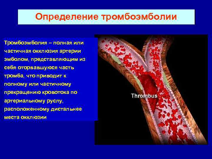 Определение тромбоэмболии Тромбоэмболия – полная или частичная окклюзия артерии эмболом, представляющим из себя оторвавшуюся