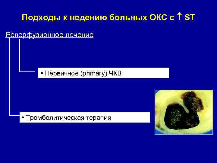 Подходы к ведению больных ОКС с ST Реперфузионное лечение • Первичное (primary) ЧКВ •