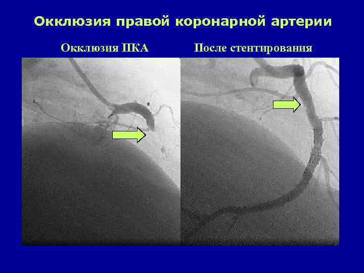 Окклюзия правой коронарной артерии Окклюзия ПКА После стентирования 