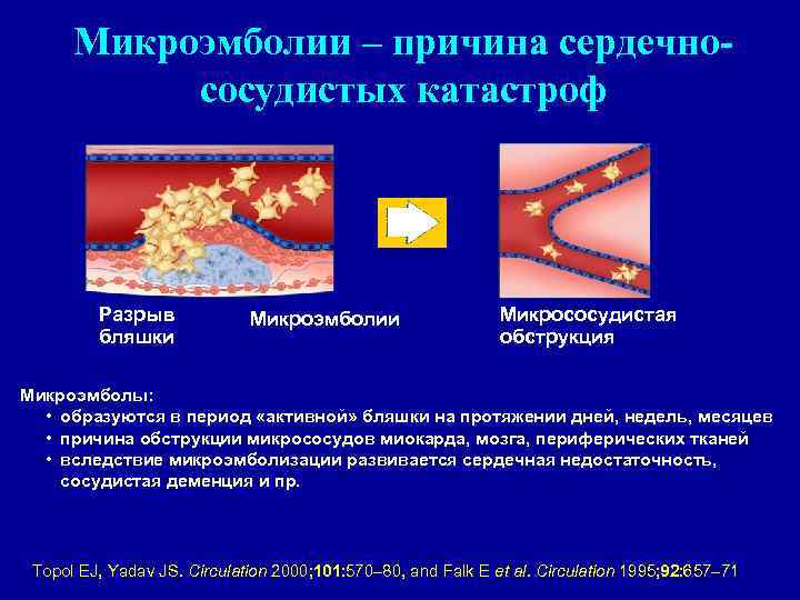 Микроэмболии – причина сердечнососудистых катастроф Разрыв бляшки Микроэмболии Микрососудистая обструкция Микроэмболы: • образуются в