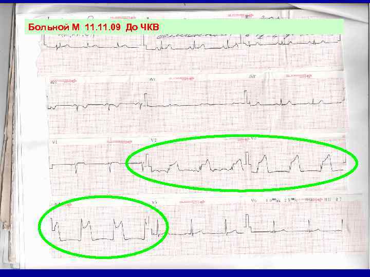 Больной М 11. 09 До ЧКВ 