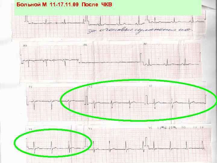 Больной М 11 -17. 11. 09 После ЧКВ 