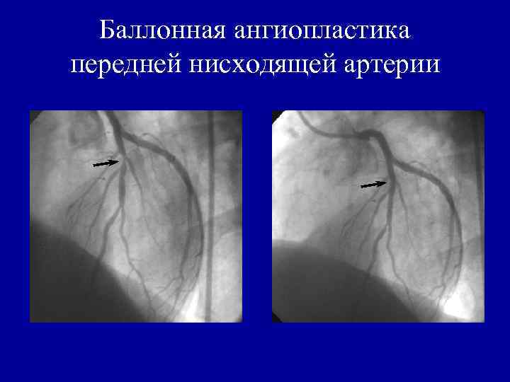 Баллонная ангиопластика передней нисходящей артерии 