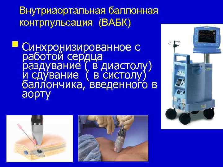 Внутриаортальная баллонная контрпульсация (ВАБК) § Синхронизированное с работой сердца раздувание ( в диастолу) и