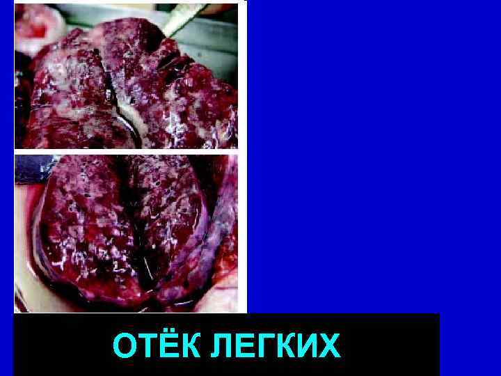 ОТЁК ЛЕГКИХ 