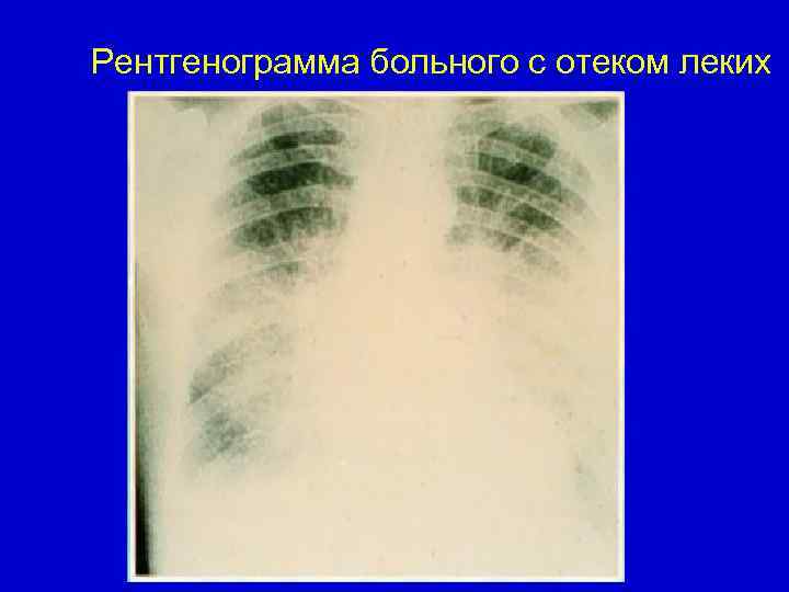 Рентгенограмма больного с отеком леких 